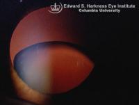 Subluxated Lens